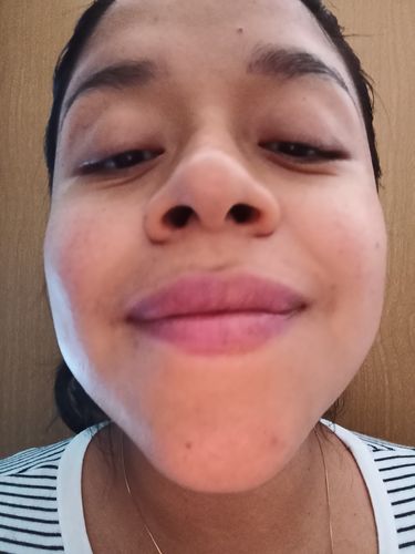 Customer photo review of Rejuvenecimiento Facial Lisse