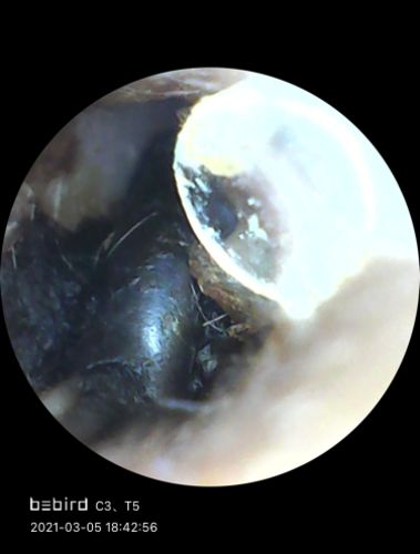 Customer photo review of Bee Gone Wax Ear Cleaner