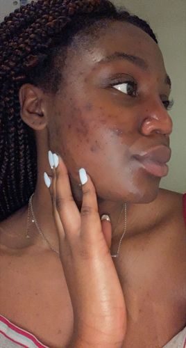 Customer photo review of HYPER G[L]O - Renewing Night Serum