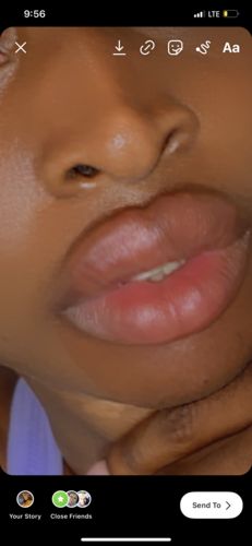 Customer photo review of LipFix: Filler