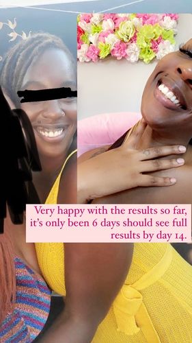 Customer photo review of LipFix: Lip Flip