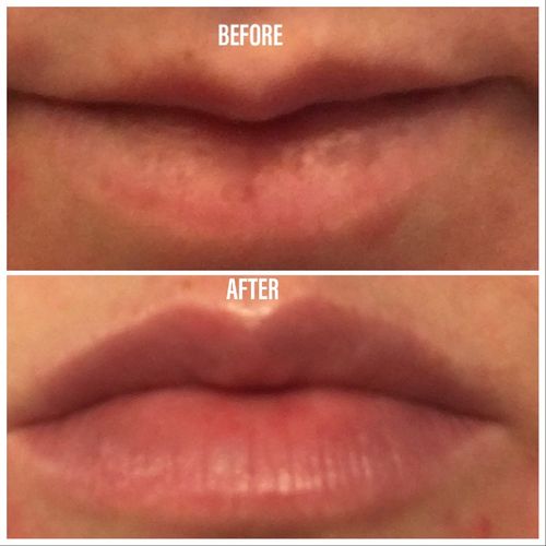 Customer photo review of Revision Skincare Lip Replenisher Plumper