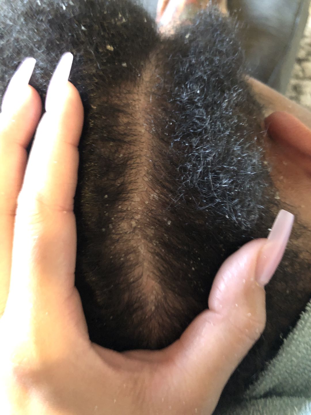Customer photo review of Psoriasis Honey Scalp Nourishing Kit