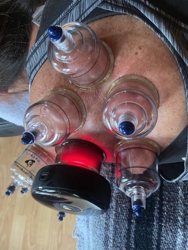 Customer photo review of Achedaway Cupper - The Smart Cupping Therapy Massager