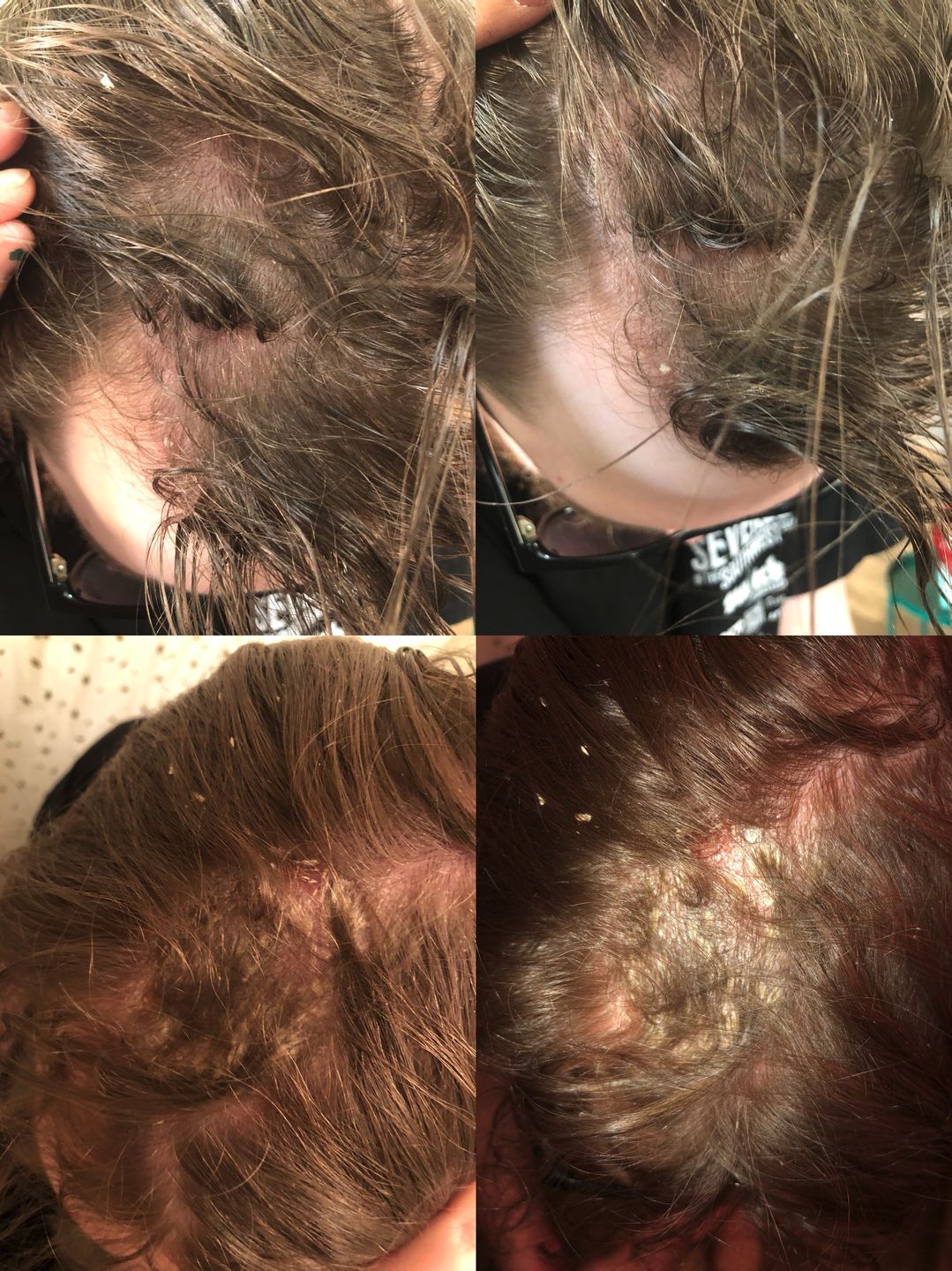 Customer photo review of Psoriasis Honey Scalp Nourishing Kit