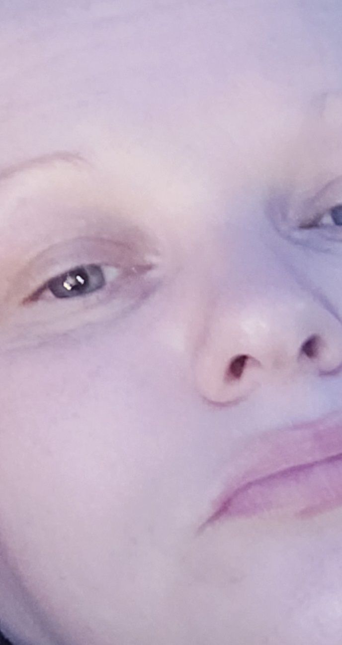 Customer photo review of Antiac Activ Gel Serum