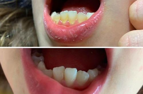 Customer photo review of SonicSmile™ Ultrasonic Tooth Cleaning Wand