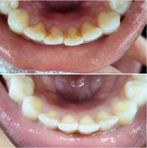 Customer photo review of SonicSmile™ Ultrasonic Tooth Cleaning Wand