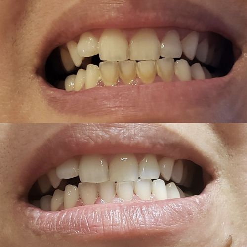 Customer photo review of SonicSmile™ Ultrasonic Tooth Cleaning Wand