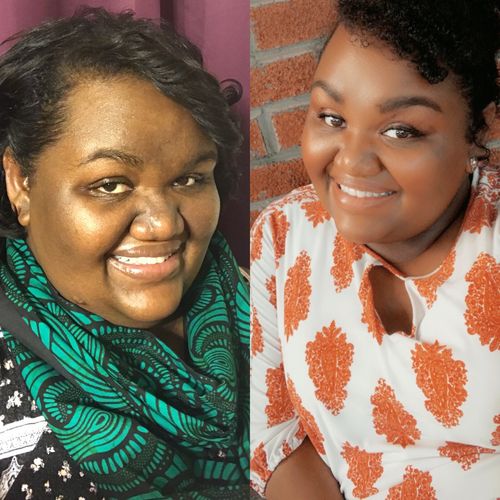 Customer photo review of BERRI-CLEAR+ 5 BERRY SUPERFRUIT SERUM