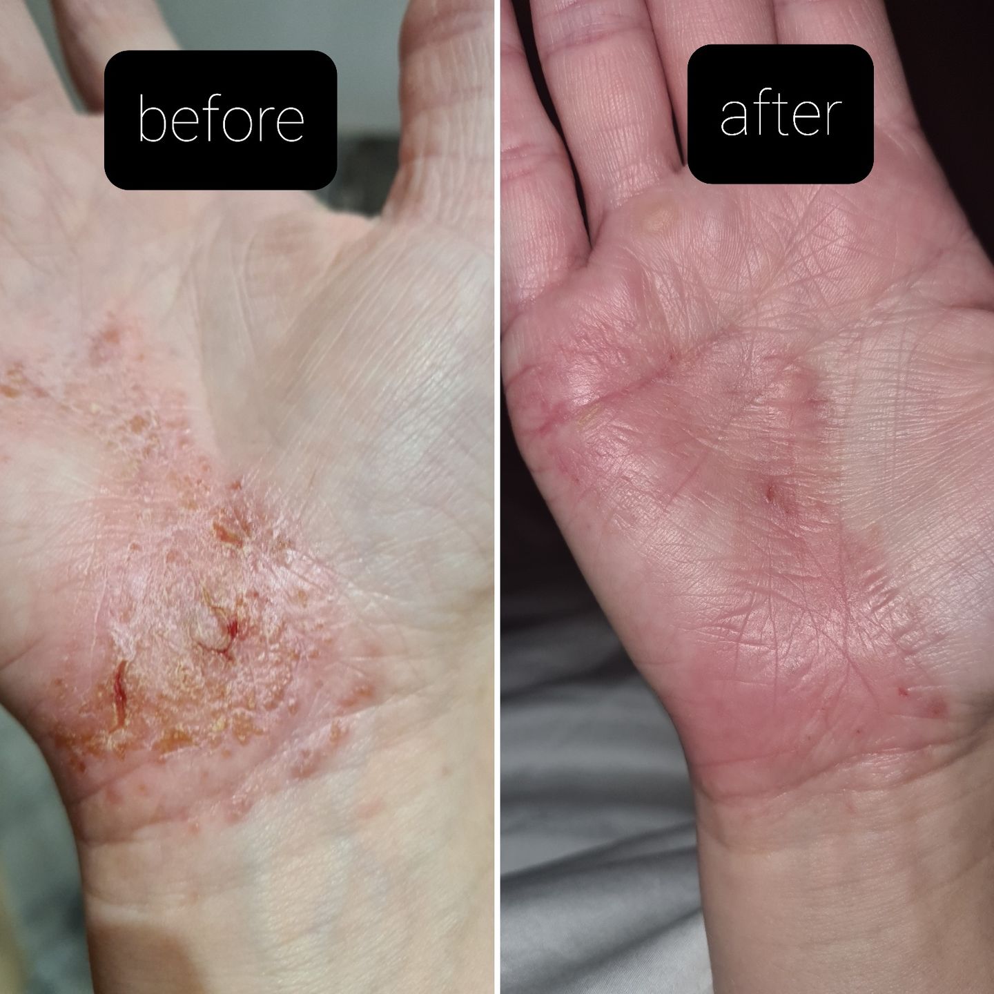 Customer photo review of Bioskin Duo Pack (Free Bioskin Zeoderm)