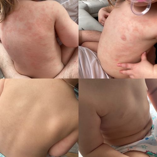 Customer photo review of Bioskin Junior Duo Pack (Free Outbreak Rescue Cream)