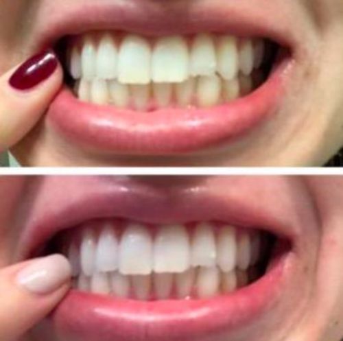 Customer photo review of SonicSmile™ Ultrasonic Tooth Cleaning Wand