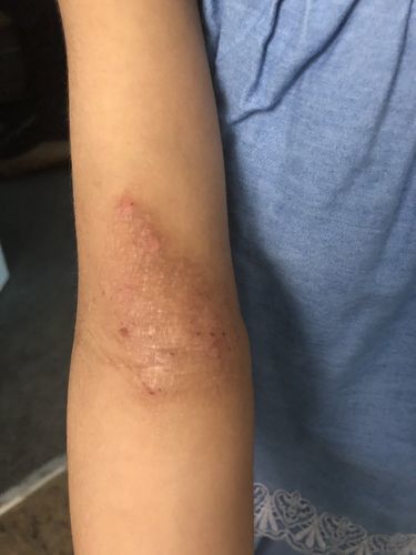 Customer photo review of Bioskin Junior Outbreak Rescue Cream