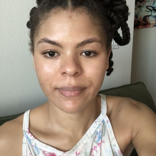 Customer photo review of Fair and White So White Acne Medication Cleanser 250ml / 8.4 fl oz