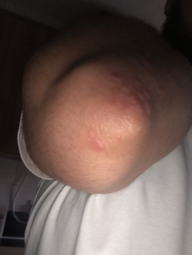 Customer photo review of Bioskin DermaSpray Intensive