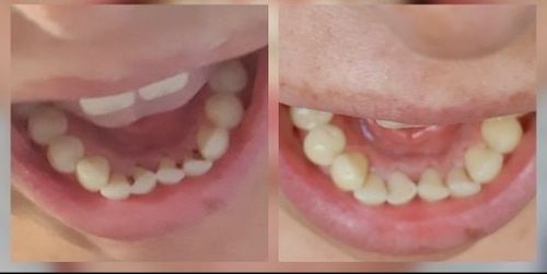 Customer photo review of SonicSmile™ Ultrasonic Tooth Cleaning Wand