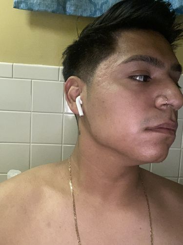 Customer photo review of JawlineFix: Filler