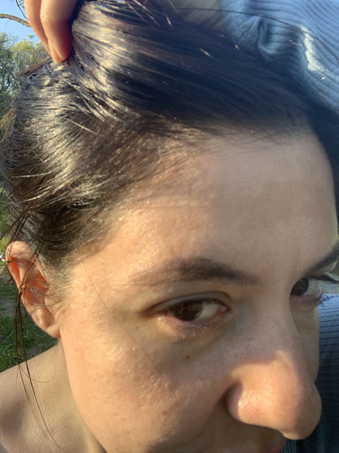 Customer photo review of Psoriasis Honey Scalp Nourishing Kit