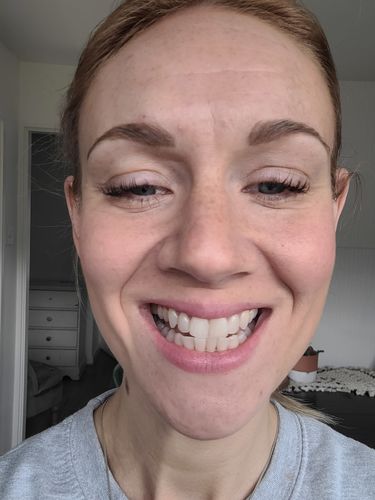 Customer photo review of Teeth Whitening Kit