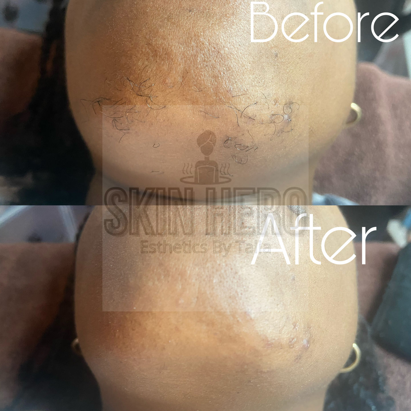 Customer photo review of At-Home Signature Series Hair Removal Wax