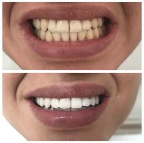 Customer photo review of Premium Zahnbleaching Set