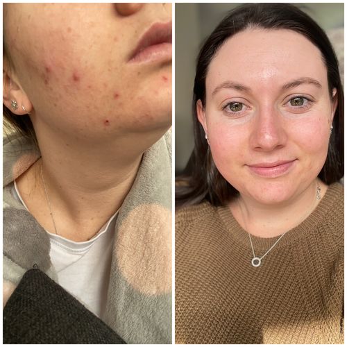Customer photo review of LOVESKIN Acne/ Combination Skincare Ritual