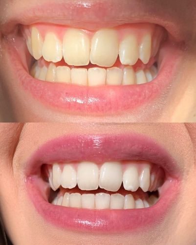 Customer photo review of Teeth Whitening Kit