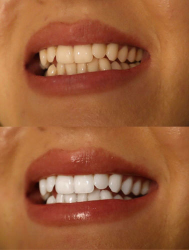 Customer photo review of Teeth Whitening Kit