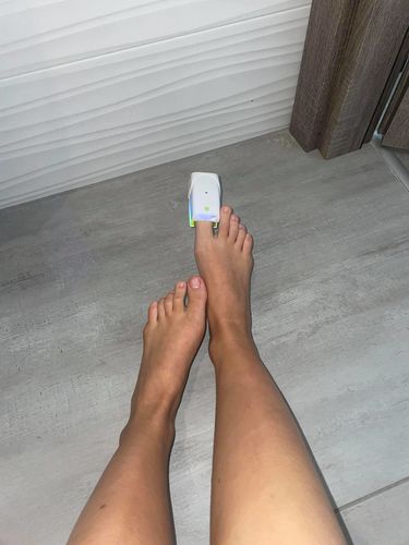 Customer photo review of Dermachom Nail Fungus Treatment