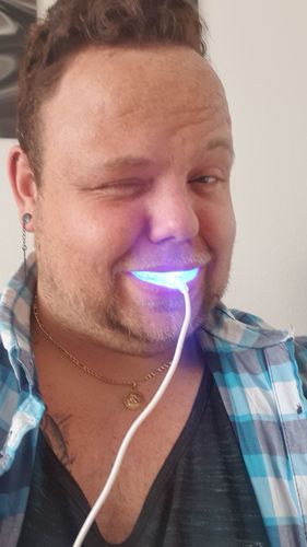 Customer photo review of PAP+ LED Teeth Whitening Kit