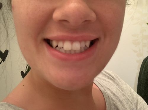Customer photo review of Teeth Whitening Kit