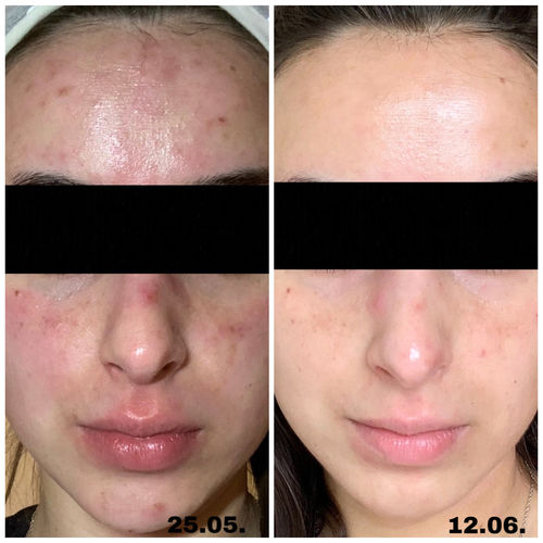 Customer photo review of GLOW DUOs