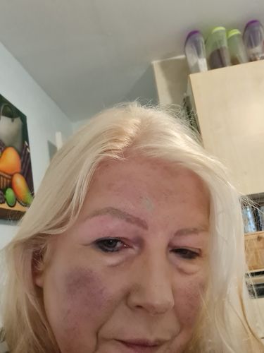 Customer photo review of Rosalique 3 in 1 Anti-Redness Miracle Formula SPF50