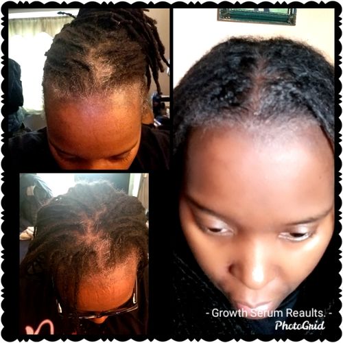 Customer photo review of Hair Growth Serum | 4 oz