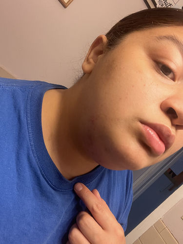 Customer photo review of ChinFix: Kybella