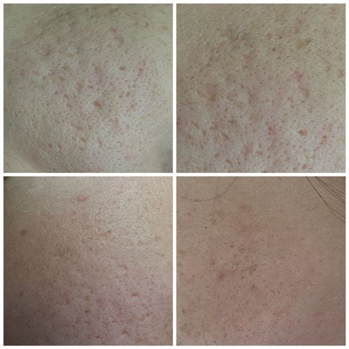 Customer photo review of Niacid