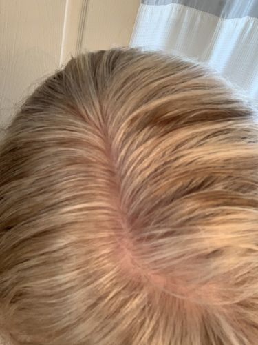 Customer photo review of THANK YOU - DHT Blocker Vitamin with Immune Support, Saw Palmetto, and Green Tea