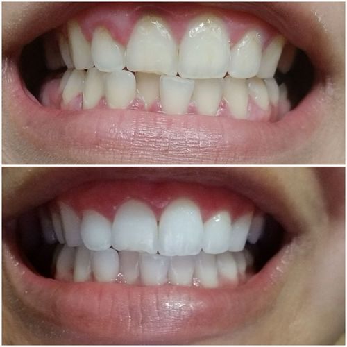 Gleam™ Teeth Whitening Kit