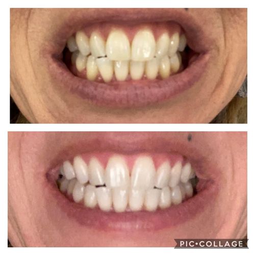 Gleam™ Teeth Whitening Kit