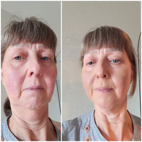 Customer photo review of Rosalique 3 in 1 Anti-Redness Miracle Formula SPF50