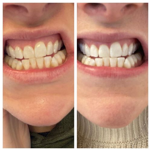 Customer photo review of Teeth Whitening Kit