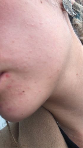 Customer photo review of High Frequency Wand