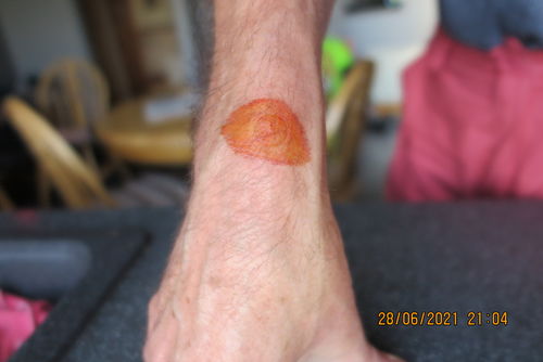 Customer photo review of Tincture Of Iodine- Antiseptic To Treat Wound & Kill Bacteria Fast