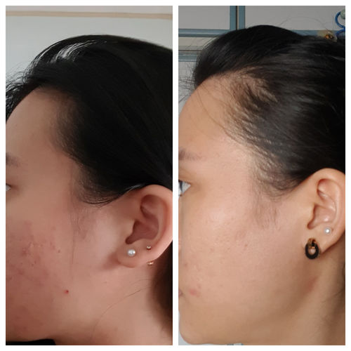 Customer photo review of Niacid