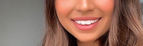 Customer photo review of PAP+ LED Teeth Whitening Kit