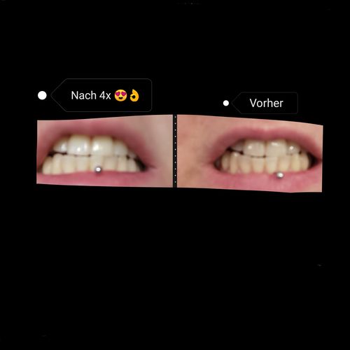 Customer photo review of PAP+ LED Teeth Whitening Kit