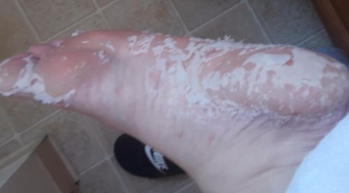 Customer photo review of Exfoliating Foot Peeling Mask by TOPQAC™