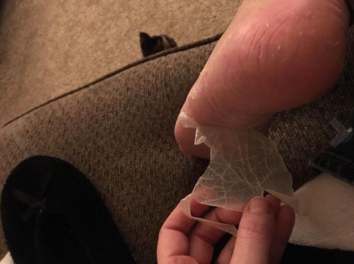 Customer photo review of Exfoliating Foot Peeling Mask by TOPQAC™