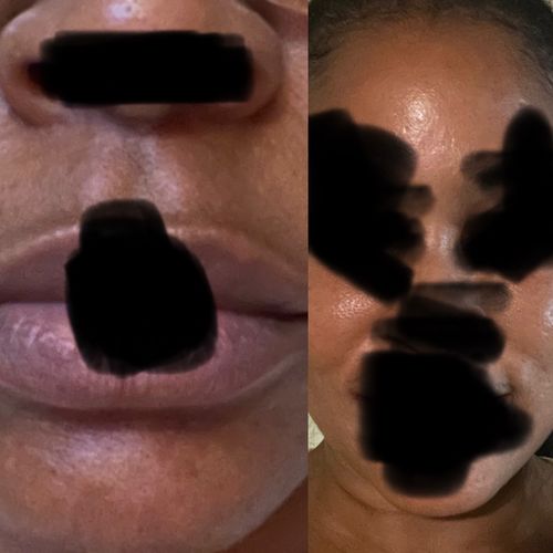 Customer photo review of 2000mg Glutathione Vitamin Rectal Suppositories (20) - Starter Pack